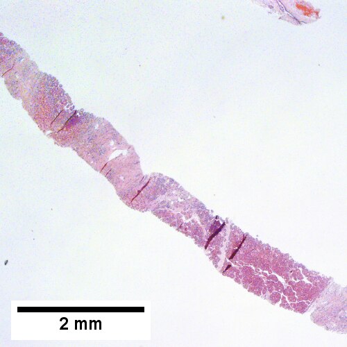 Fibrous bands dissect hepatocyte nodules, mostly hepatoma(Row 1 Left 20X).