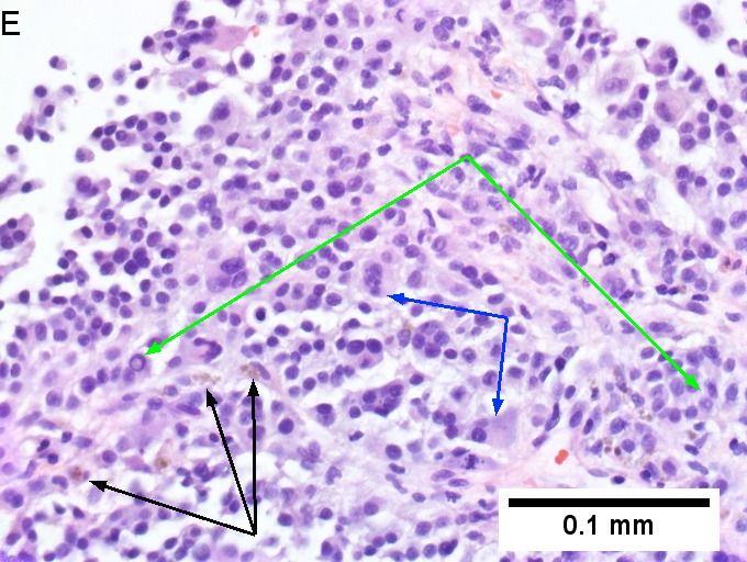 Melanoma metastatic to liver.