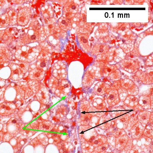 Steatohepatitis. Brunt necroinflammatory grade 1. Brunt fibrosis stage 1.