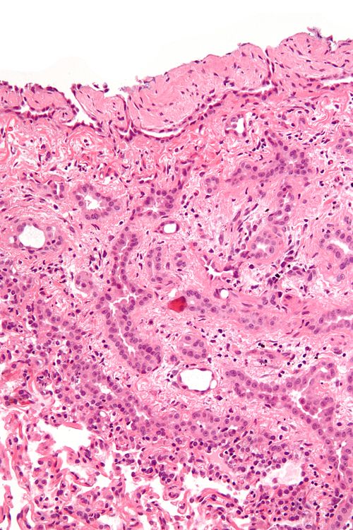 Malignant epithelioid mesothelioma - high mag.jpg