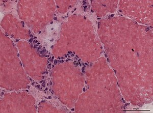 Polymyositis muscle biopsy HE.jpg