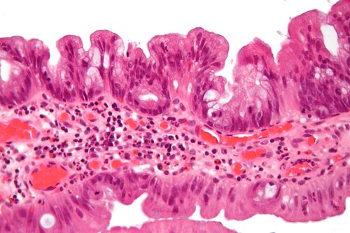 Traditional serrated adenoma very high mag.jpg