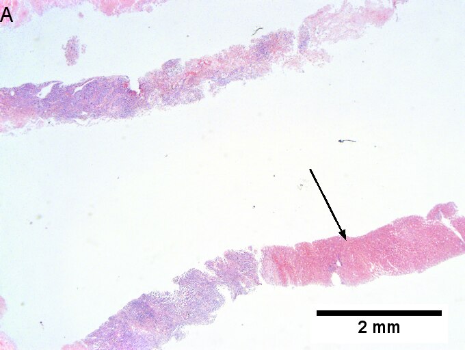 Melanoma metastatic to liver.