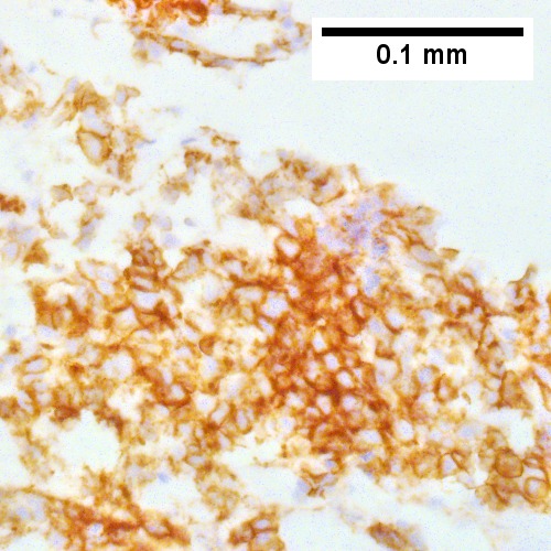 Metastatic poorly differentiated neuroendocrine carcinoma of pulmonary origin.