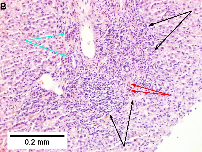 Drug induced liver injury in a young adult man