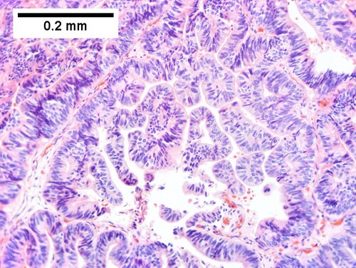 Intraductal papillary neoplasm of common bile duct with associated invasive carcinoma.