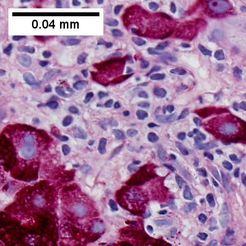 PAS without diastase shows piecemeal necrosis (not very good on wedge biopsies in my experience)
