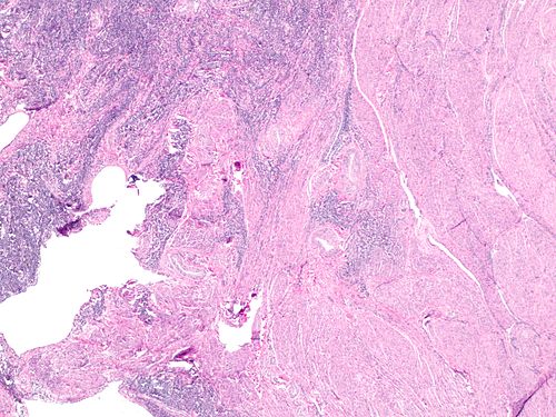 Highly cellular leiomyoma at edge to myometrium at 20x.jpg