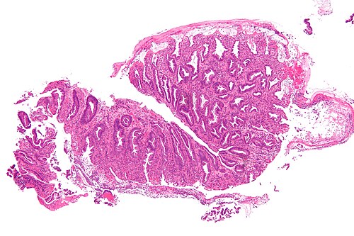 Ischemic colitis - low mag.jpg