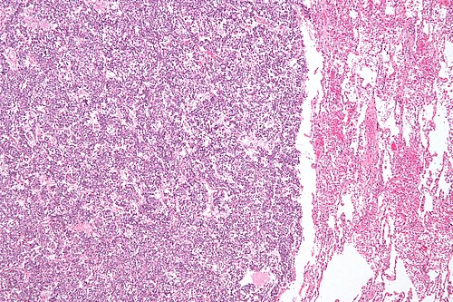 Lung carcinoid - low mag.jpg