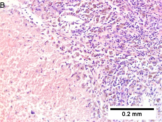 Melanoma metastatic to liver.