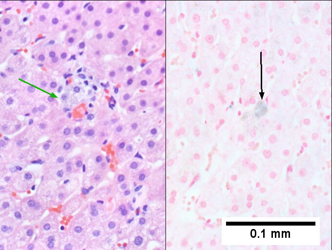 Hemocrhomatosis with DILI canalicular cholestasis with mild hepatocyte injury in the form of regeneration.