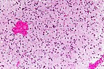 Anaplastic astrocytoma - high mag.jpg