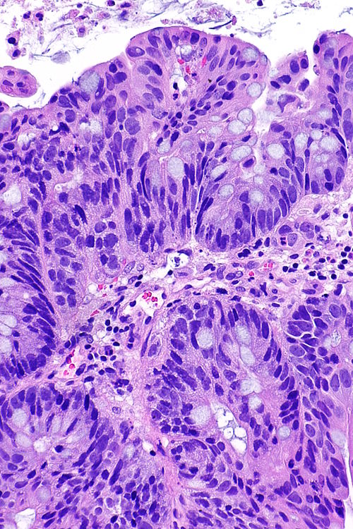 Adenocarcinoma of the urinary bladder -- high mag.jpg