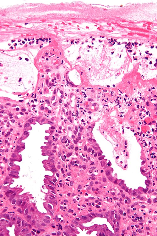 Ischemic colitis - very high mag.jpg