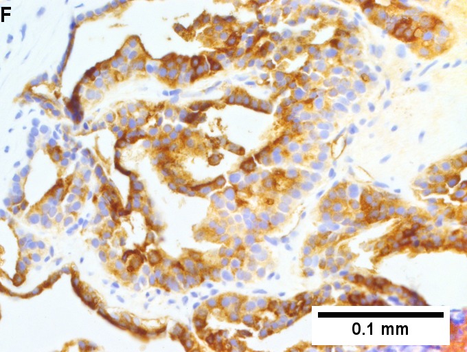 Metastatic thyroid carcinoma to liver