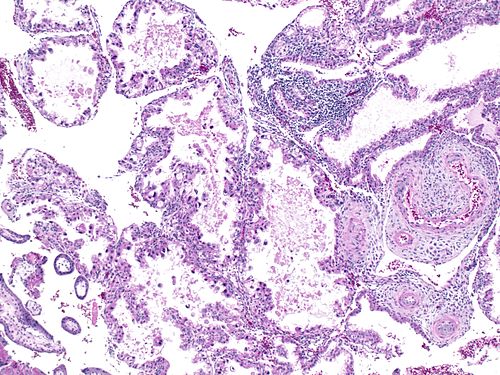 Ariasstella changes in endometrium 4x.jpg