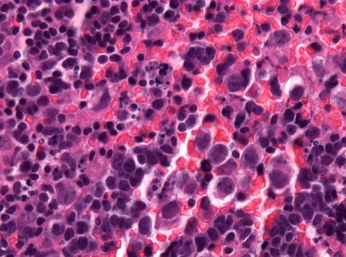 Neuropathology case VIII 03.jpg