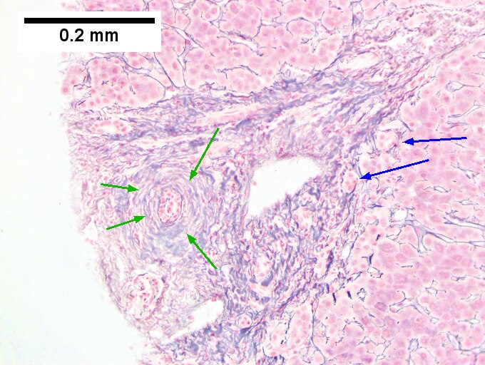 Primary sclerosing cholangitis in patient with history of ulcerative colitis.