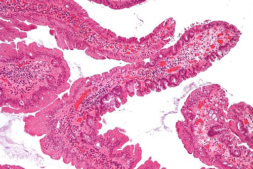 Traditional serrated adenoma low mag.jpg