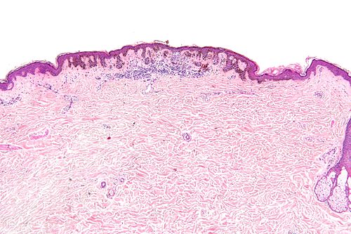 Dysplastic nevus - low mag.jpg