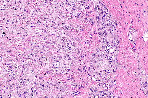 Sarcomatoid prostate carcinoma -- intermed mag.jpg