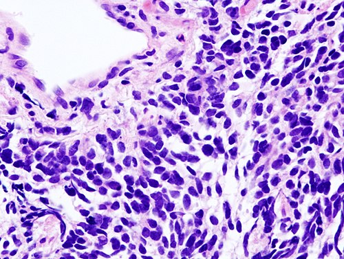 Lung small cell carcinoma (1) by core needle biopsy.jpg