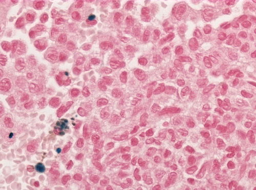 Neuropathology case VII 04.jpg