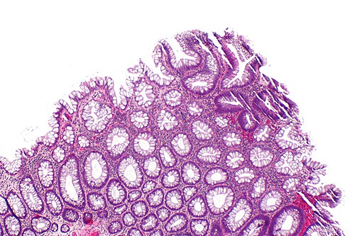Tubular adenoma - ase -- low mag.jpg