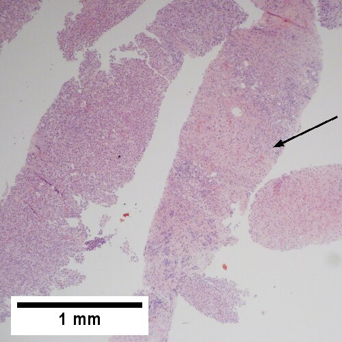 Hepatocellular carcinoma with fragments of liver afflicted by steatosis & with regenerative, benign fragments.