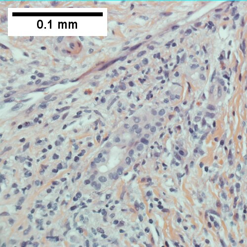 Damaged bile duct (400X).