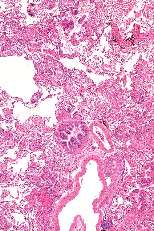 Lymphangioleiomyomatosis - low mag.jpg