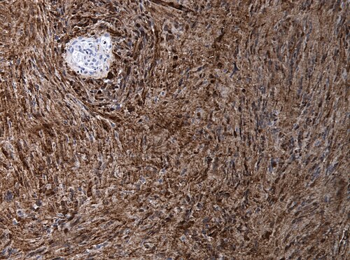 Neuropathology case I-Gomorri 07.jpg