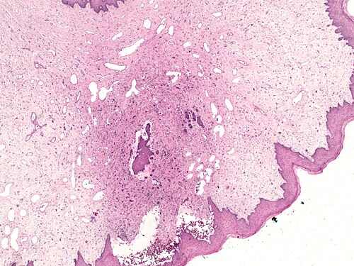 Fibroepithelial polyp of the vulva with atypical cells on low magnification.jpg
