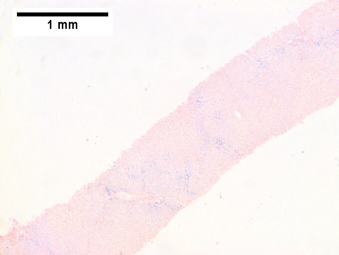 Hemocrhomatosis with DILI canalicular cholestasis with mild hepatocyte injury in the form of regeneration.