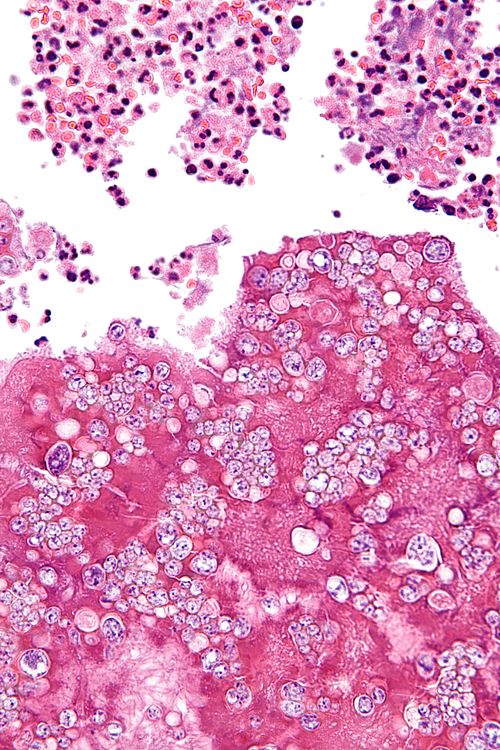 Coccidioidomycosis - very high mag.jpg