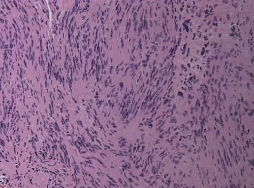 Neuropathology case I-Gomorri 04.jpg