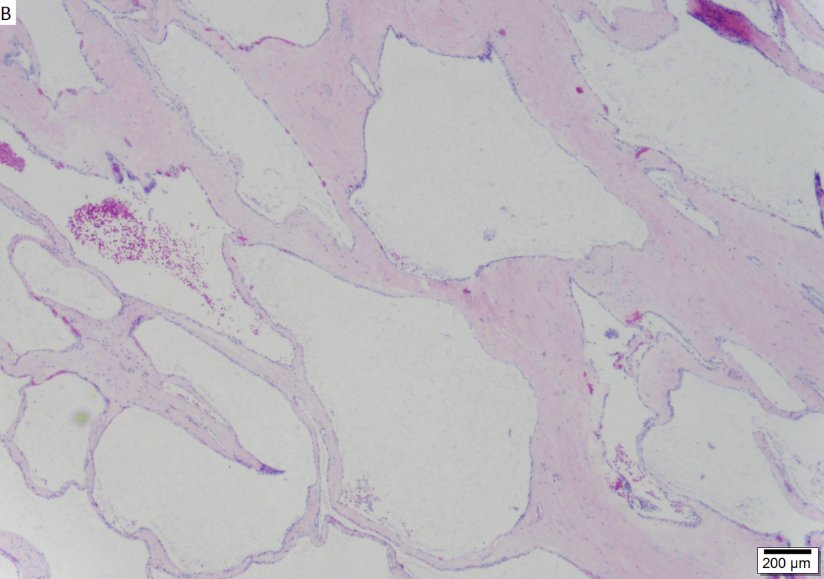 Microcystic serous cystadenoma of pancreas