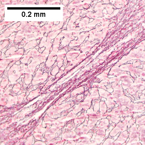 HCR. Metavir Activity Index 2 (PMN 1 LN 2) Metavir fibrosis stage 3.