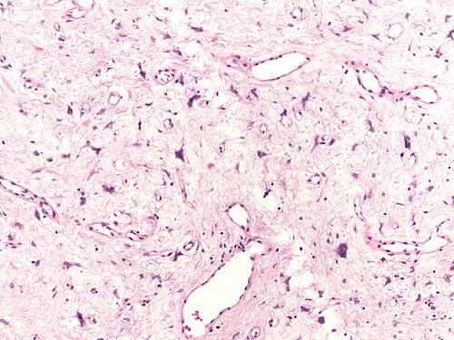 Fibroepithelial polyp of the vulva.jpg