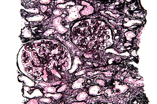 Membranous nephropathy - mpas - high mag.jpg