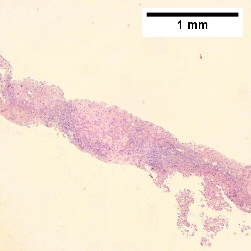 Alpha 1 Antitrypsin deficiency with cirrhosis