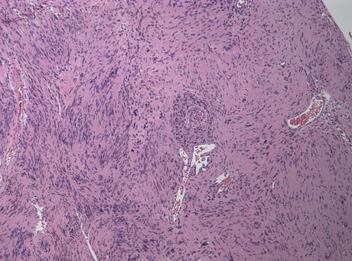 Neuropathology case I-Gomorri 02.jpg