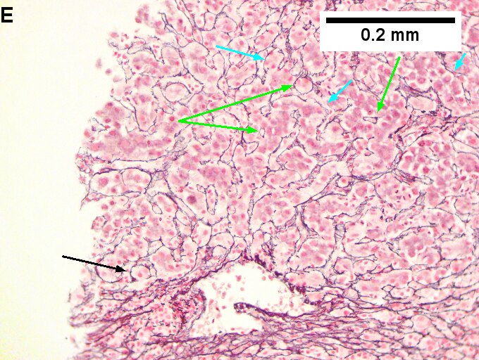 Drug induced liver injury in a young adult man