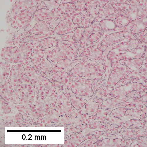 Hepatocellular carcinoma with fragments of liver afflicted by steatosis & with regenerative, benign fragments.