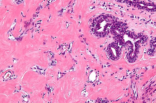 Pseudoangiomatous stromal hyperplasia - high mag.jpg