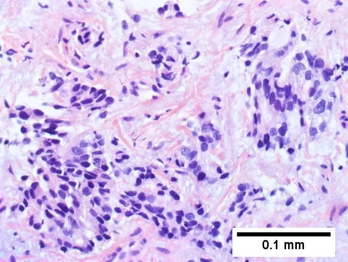 Cholangiocarcinoma, intrahepatic, small duct type.