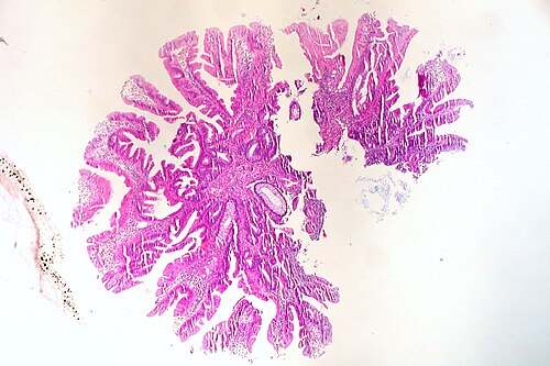 Traditional Serrated Adenoma of Colon (5204504400).jpg