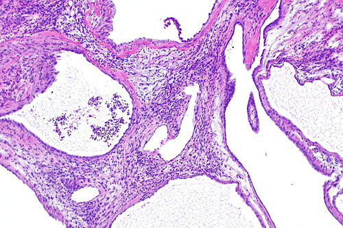 Cystic nephroma -- low mag.jpg