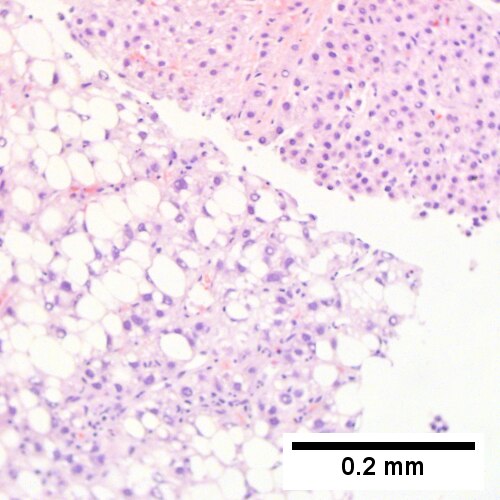 Hepatocellular carcinoma with fragments of liver afflicted by steatosis & with regenerative, benign fragments.